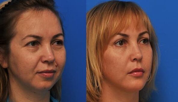 avant et après rajeunissement de la peau avec raffermissement photo 1