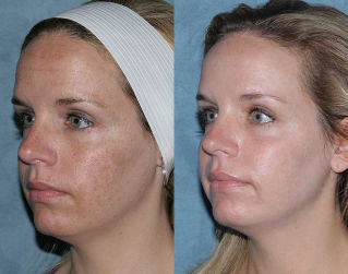 Photos avant et après fractionné le rajeunissement facial