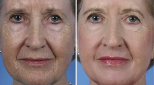 rajeunissement partiel du visage avant et après les photos