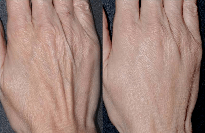 contour plastique, rajeunissement des mains photo 2 avant et après